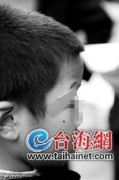 小學生遭體罰撞傷眉骨 因上了“上課搗蛋”名單